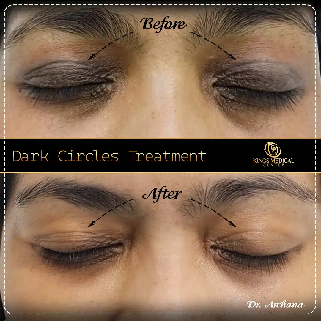 Dark Circle Treatment