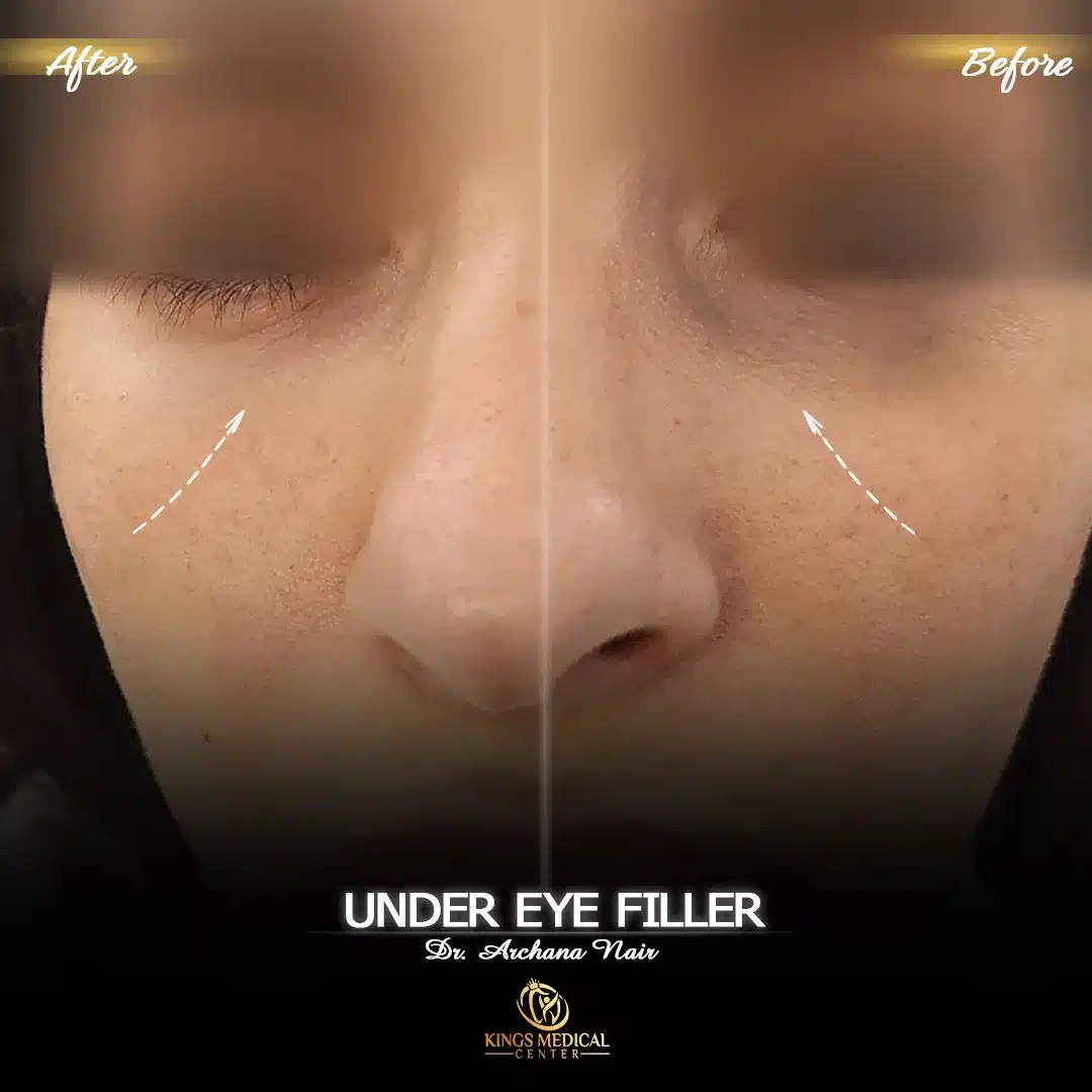 Under Eye Filler