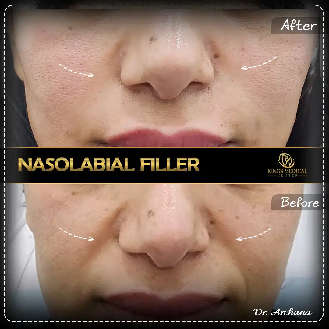 Nasolabial Filler
