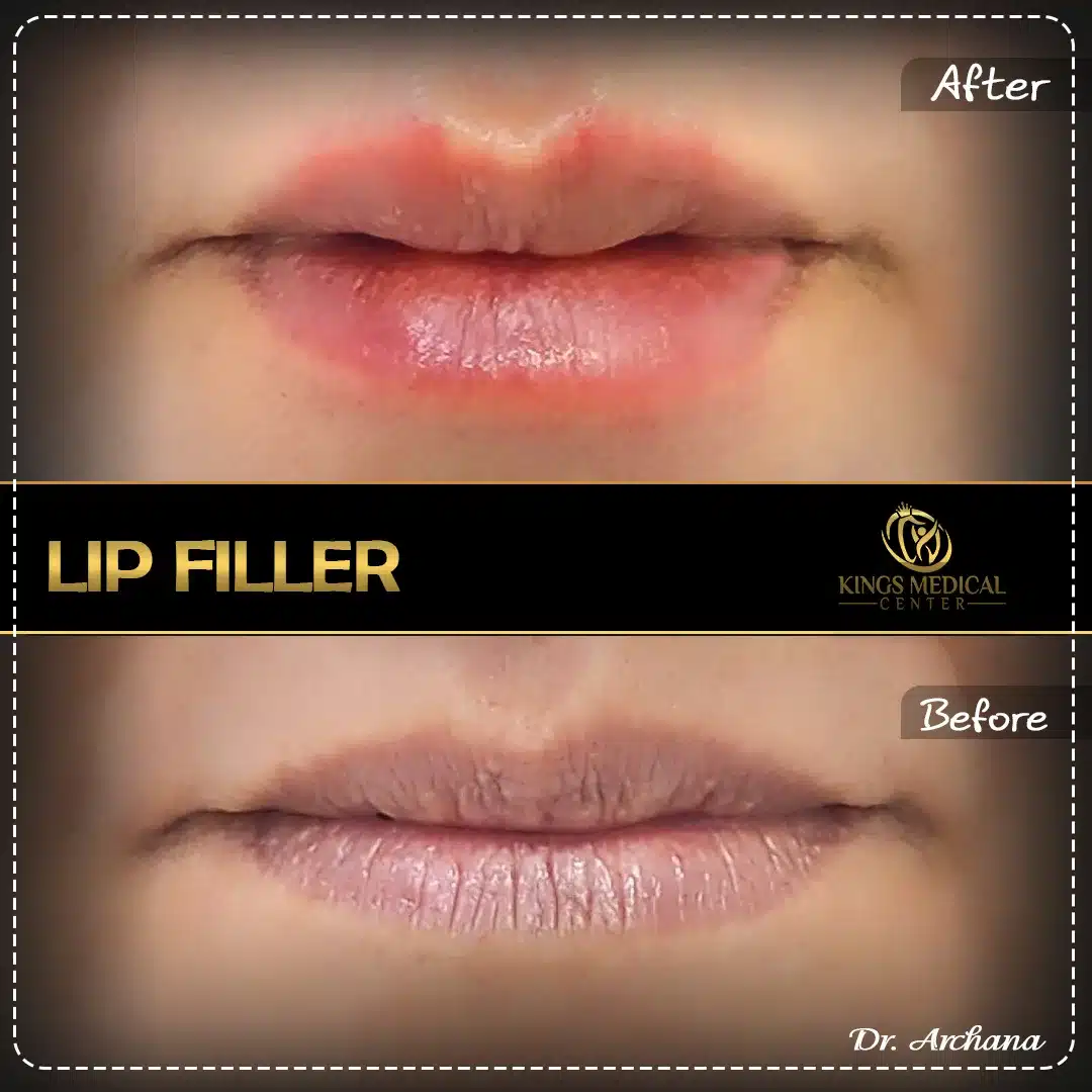Lip Filler