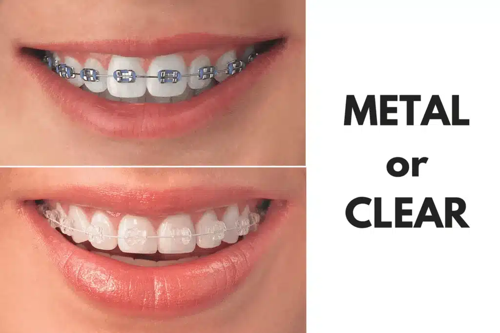 Metal Braces vs clear braces