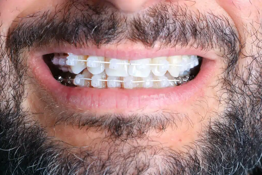 Clear Braces - Kings MC